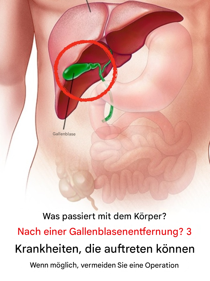 Was passiert mit Ihrem Körper nach einer Gallenblasenentfernung? 3 Erkrankungen, die eine Gallenblasenentfernung erforderlich machen können – Vermeiden Sie die Operation nach Möglichkeit.