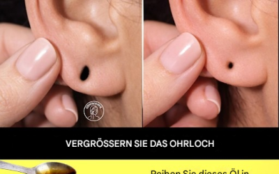Wie man abstehende Ohrläppchen auf natürliche Weise zu Hause reduzieren kann