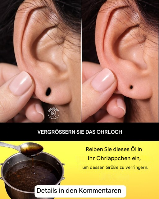 Wie man abstehende Ohrläppchen auf natürliche Weise zu Hause reduzieren kann