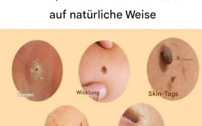 Wie kann man Muttermale, Warzen, Mitesser, Hautwucherungen und Altersflecken auf natürliche Weise entfernen?