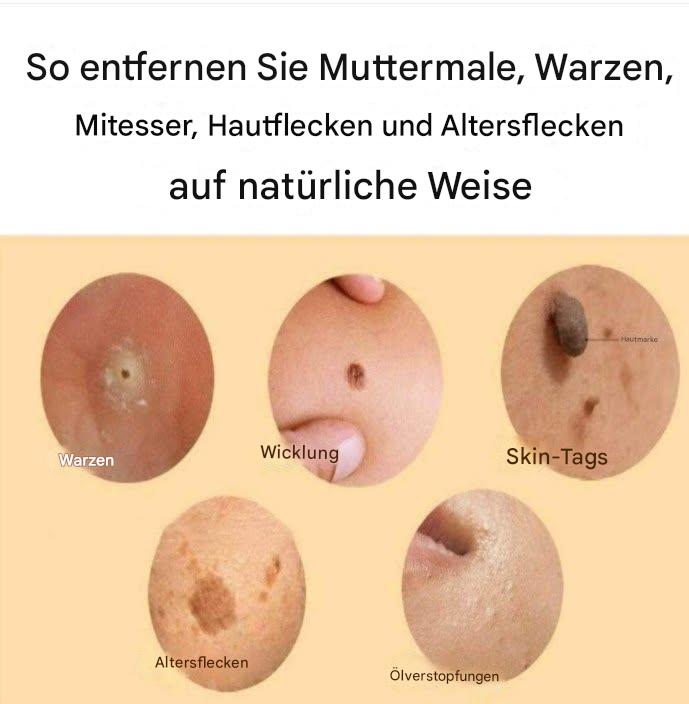 Wie kann man Muttermale, Warzen, Mitesser, Hautwucherungen und Altersflecken auf natürliche Weise entfernen?