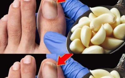 Knoblauch: Eine natürliche Lösung für Nagelpilz