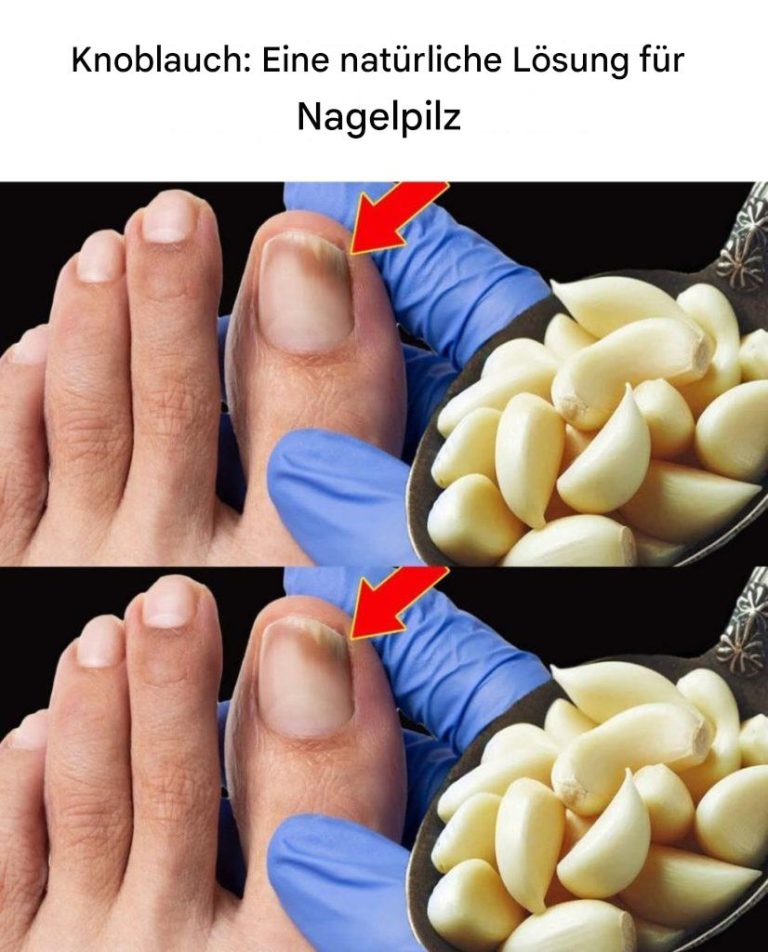 Knoblauch: Eine natürliche Lösung für Nagelpilz
