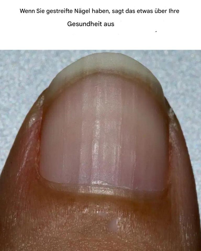 Wenn Sie Rillen auf Ihren Nägeln haben, sagt das etwas über Ihre Gesundheit aus