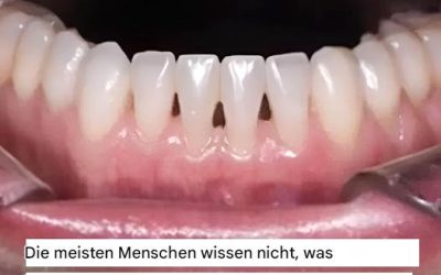 Was bedeuten schwarze Dreiecke zwischen den Zähnen? Ein Zahnarzt erklärt!