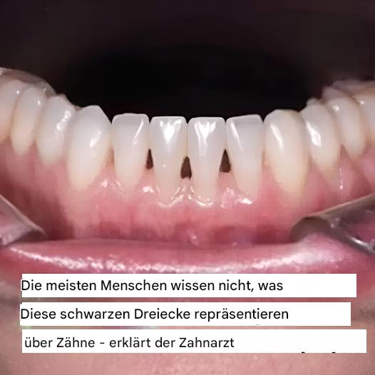 Was bedeuten schwarze Dreiecke zwischen den Zähnen? Ein Zahnarzt erklärt!