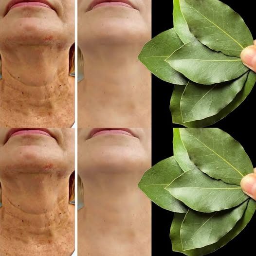 Lorbeerblätter sind 100.000 Mal stärker als Botox? | Natürlicher Faltenentferner sogar mit 70!