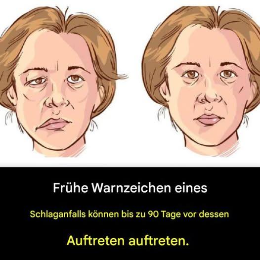 Frühe Warnzeichen eines Schlaganfalls können bis zu 90 Tage vor dessen Auftreten auftreten.