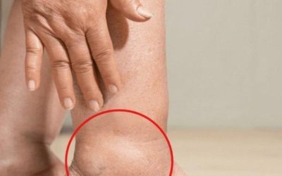 Warum schwellen Ihre Knöchel an? Wie können Sie dem vorbeugen?