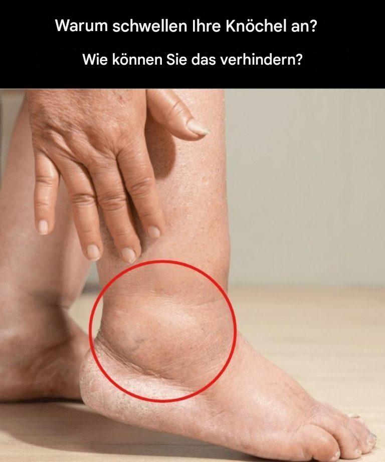 Warum schwellen Ihre Knöchel an? Wie können Sie dem vorbeugen?