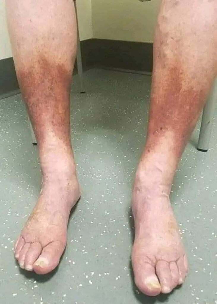 Was sind die frühen Symptome der Lou-Gehrig-Krankheit?