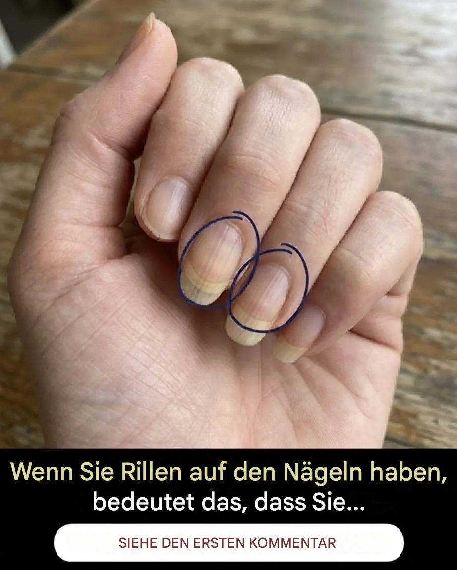 Wenn Sie Rillen auf Ihren Nägeln haben, bedeutet das Folgendes:
