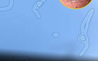 Was sind Glaskörpertrübungen? Was Sie laut einem Augenarzt tun sollten, wenn Sie sie bemerken.