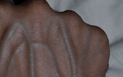 Wenn Ihre Venen an der Hand sichtbar sind, ist das ein Anzeichen für Krebs… Mehr anzeigen