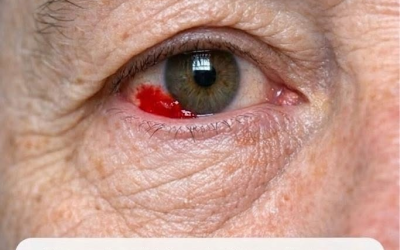 Mein 64-jähriger Mann wachte mit einem roten, blutenden Fleck am Auge auf. Sollten wir ins Krankenhaus fahren?