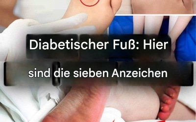 Diabetischer Fuß: Achten Sie auf diese 7 Anzeichen (1/2)