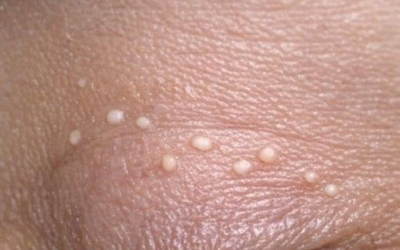 Kleine weiße Pünktchen auf den Augenlidern: Was sie sind, warum sie auftreten und was man dagegen tun kann.