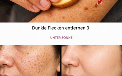 Beseitigt Altersflecken, Melasma, Sonnenflecken, Hautunreinheiten und Zeichen der Hautalterung.