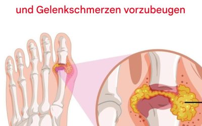 So können Sie Gicht auf natürliche Weise umkehren und Gelenkschmerzen lindern
