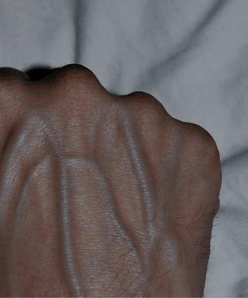 Warum Venen mit zunehmendem Alter sichtbarer werden