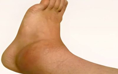 Geschwollene Knöchel und Füße erklärt: Die Ursachen aufgedeckt!