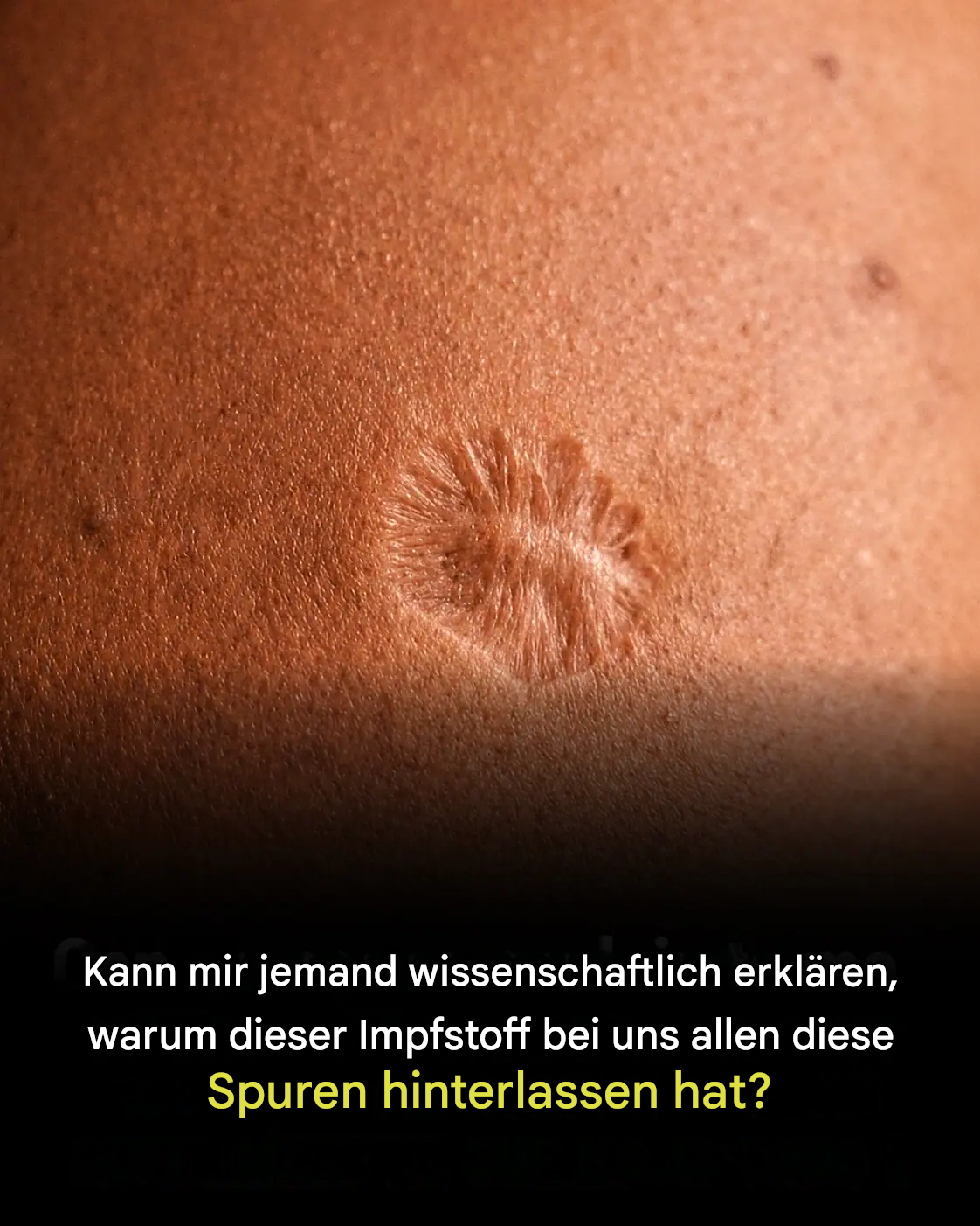 Pockenimpfungsnarbe: Warum entsteht das?
