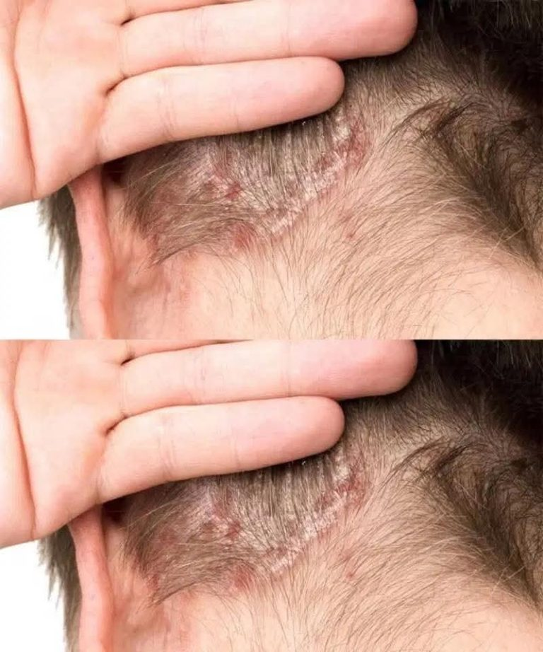 Ich habe das auf der Kopfhaut meines Sohnes entdeckt. Ich habe keine Ahnung, was es ist, und wir können momentan keinen Arzttermin bekommen. Haben Sie vielleicht einen Rat für mich?