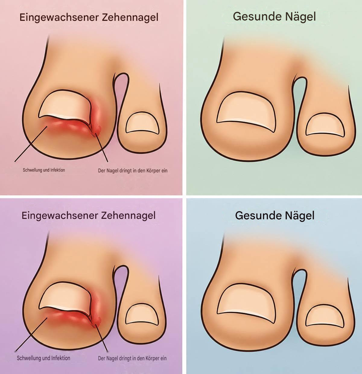 Eingewachsene Zehennägel: Wie man sie schnell und natürlich zu Hause behandelt