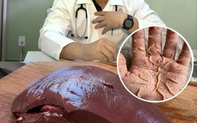 Ärzte befürchten, dass Rinderleber im Futter verursacht werden könnte… Weiterlesen
