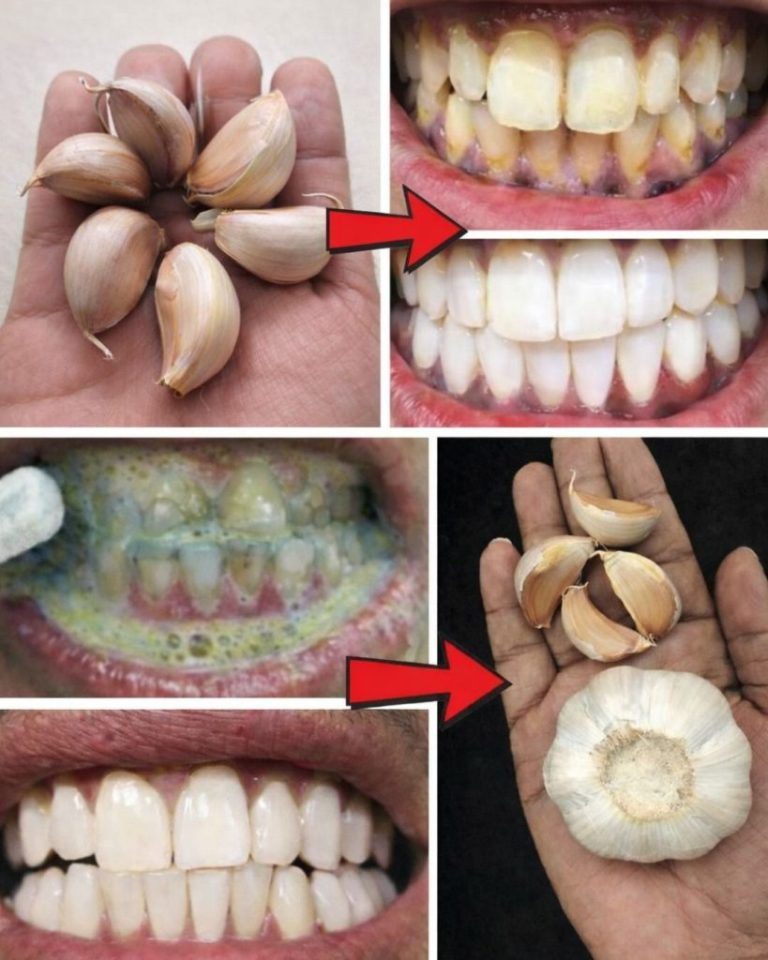 Nutzen Sie die natürliche Kraft des Knoblauchs für ein gesünderes Lächeln.