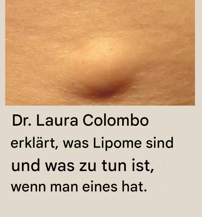 Dr. Laura Colombo erklärt, was Lipome sind und was zu tun ist, wenn man eines hat (1/2).