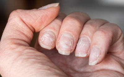 Nagelpilz: Wie man ihn mit Wasserstoffperoxid und anderen wirksamen Mitteln bekämpft