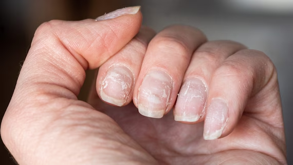 Nagelpilz: Wie man ihn mit Wasserstoffperoxid und anderen wirksamen Mitteln bekämpft