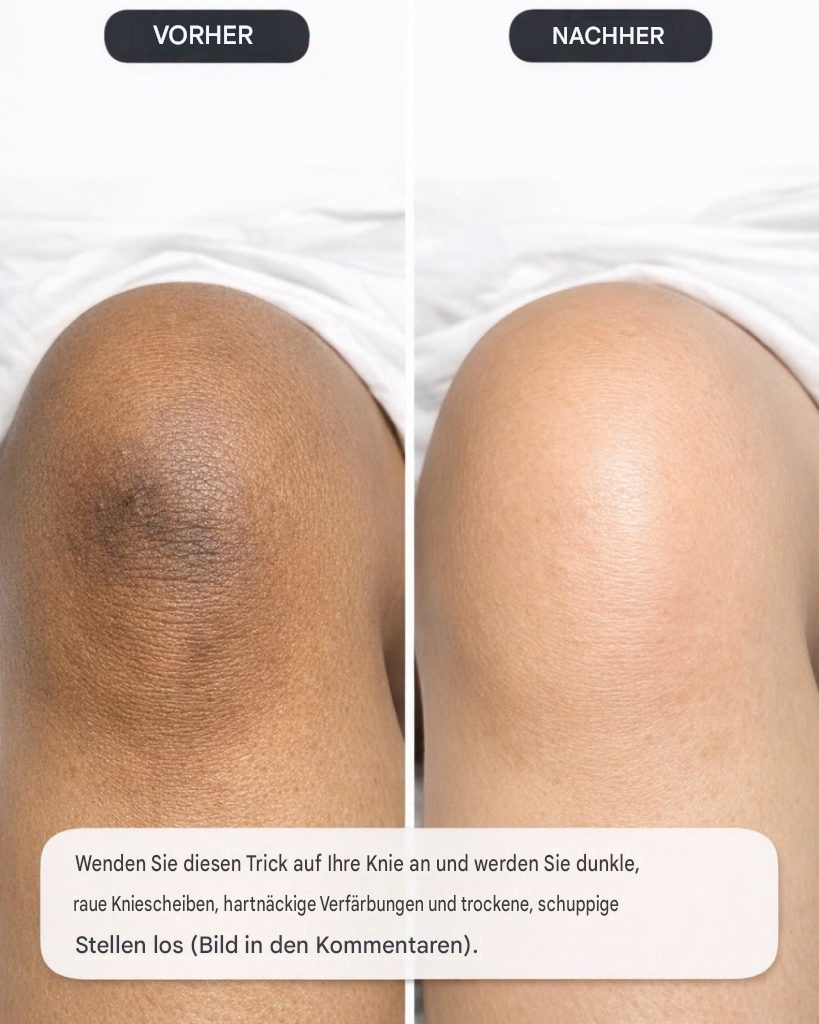 Mit diesem einen Trick für Ihre Knie werden Sie dunkle, raue Kniescheiben, hartnäckige Verfärbungen und trockene, schuppige Stellen los.