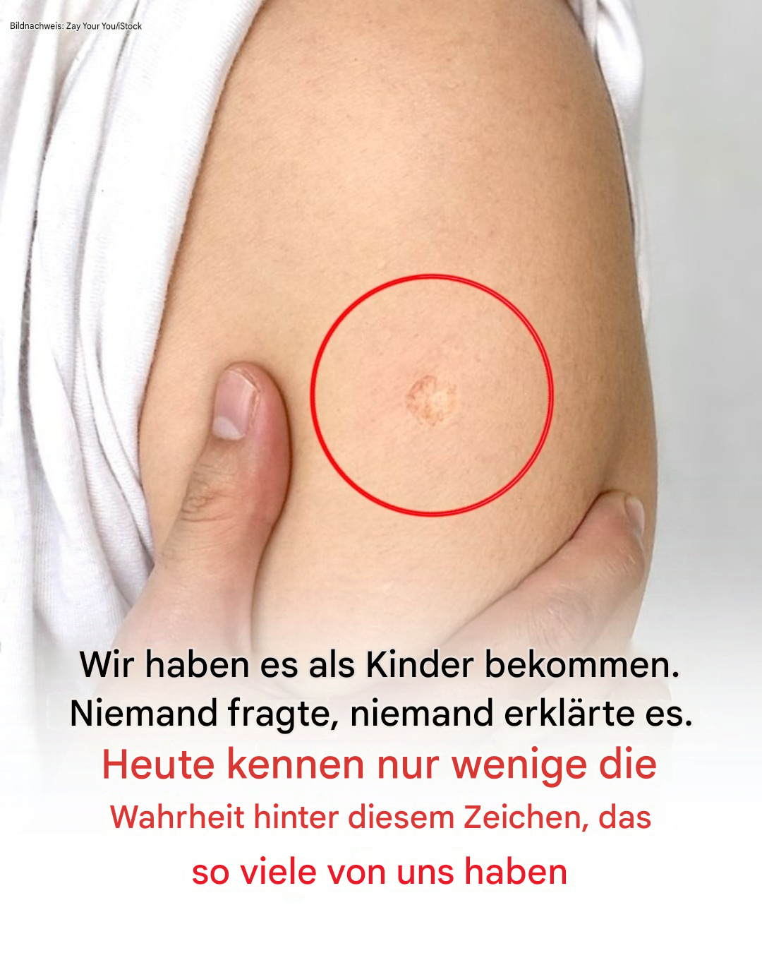 Die Wahrheit hinter der mysteriösen runden Narbe am Oberarm