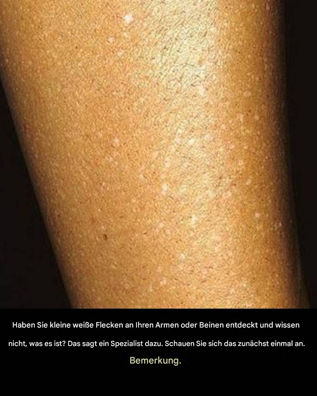 Haben Sie kleine weiße Flecken an Ihren Armen oder Beinen bemerkt… und wissen nicht, was sie sind?