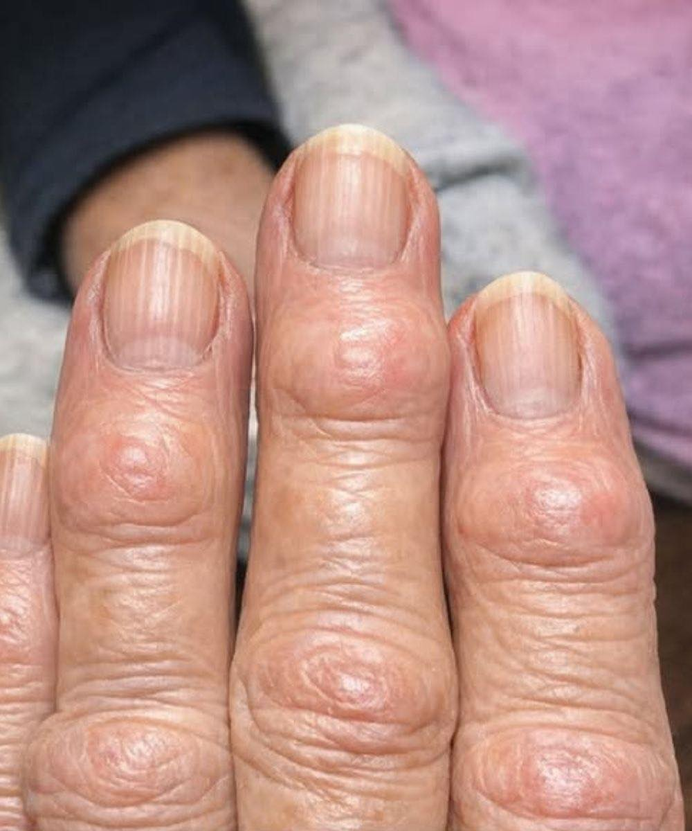 Meine Oma hat diese harten Beulen an den Fingergelenken in der Nähe der Nägel. Warum breiten sie sich aus?