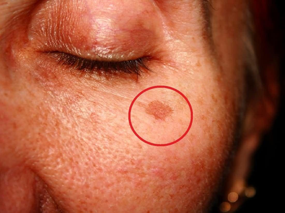Was bedeutet es, diese Flecken im Gesicht zu haben, und wie kann man sie loswerden?