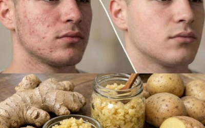 Unglaublich! In nur 20 Minuten hat ER mit Kartoffeln und Ingwer Pickel und Hautunreinheiten im Gesicht beseitigt. Das Rezept für die Mischung und die Anleitung findet ihr hier: