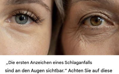 „Die ersten Anzeichen eines Schlaganfalls sind an den Augen sichtbar.“ Achten Sie auf Folgendes: