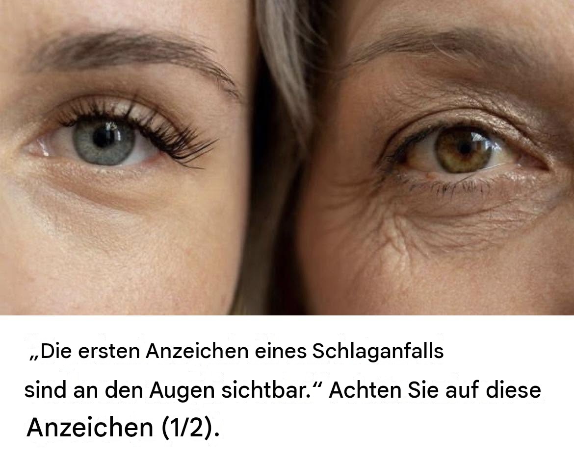 „Die ersten Anzeichen eines Schlaganfalls sind an den Augen sichtbar.“ Achten Sie auf Folgendes: