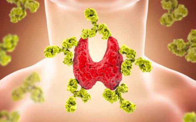 Hashimoto-Thyreoiditis: Hier sind die Symptome, auf die Sie achten sollten