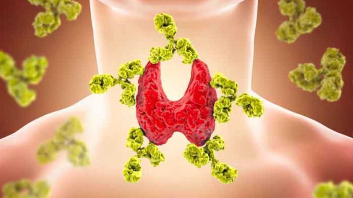 Hashimoto-Thyreoiditis: Hier sind die Symptome, auf die Sie achten sollten