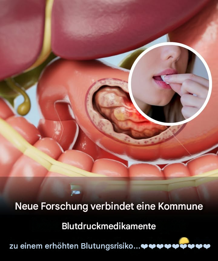 Neue Forschungsergebnisse bringen ein gängiges Blutdruckmedikament mit einem erhöhten Blutungsrisiko in Verbindung.