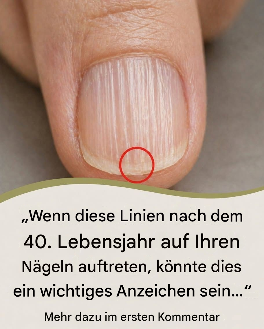 Warum bilden sich nach dem 40. Lebensjahr vertikale Rillen auf den Fingernägeln? Hier ist die Wahrheit.