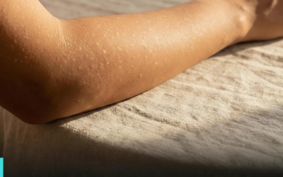 Welche Vitaminmängel können zu weißen Flecken auf der Haut führen?