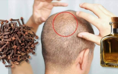 Mit 75 Jahren wachsen die Haare sogar an kahlen Stellen wieder nach! So kann Nelkenöl das Haarwachstum anregen.