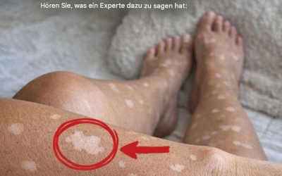 Warum entstehen weiße Flecken auf den Nägeln?