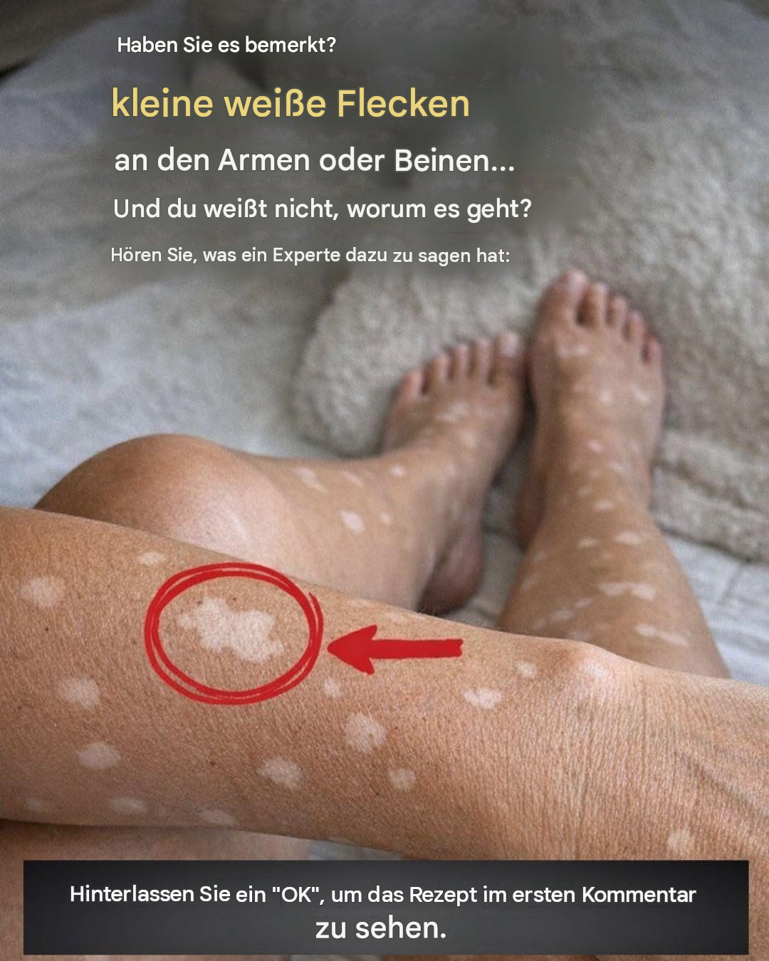 Warum entstehen weiße Flecken auf den Nägeln?