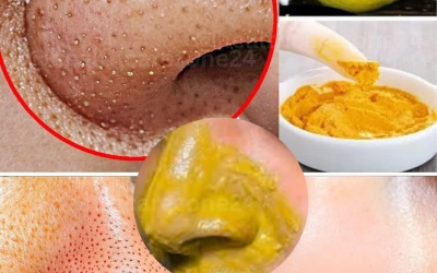 Verabschiede dich von Mitessern und Pickeln! Entferne sie auf natürliche Weise zu Hause… Hinterlasse einen Kommentar, um weiterhin meine Rezepte zu erhalten… Vielen Dank!